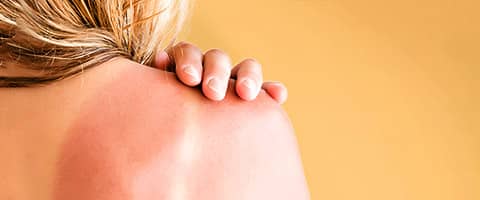 Coups de soleil : comment les soulager efficacement ?